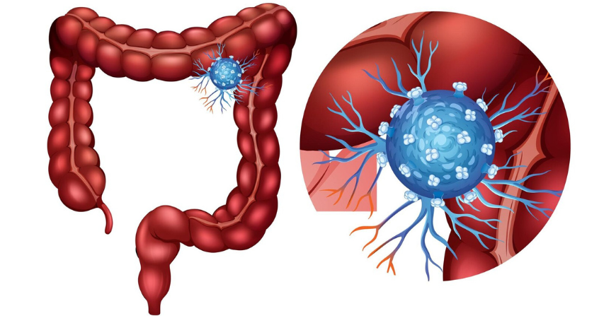 Colorectal Cancer
