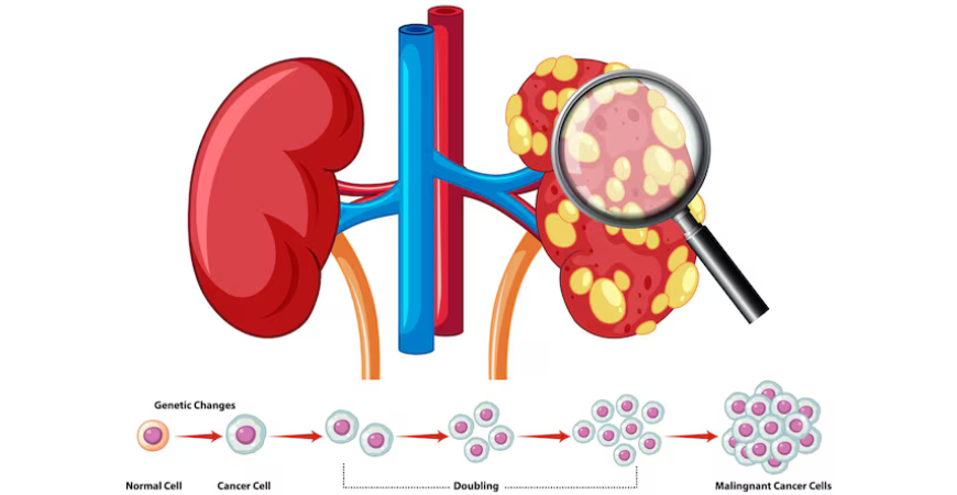 Kidney & Bladder Cancers
