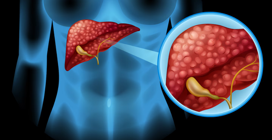 Liver & Pancreatic Cancers