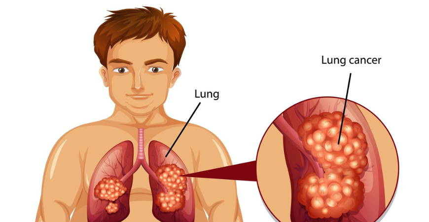 Lung Cancer